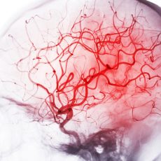 Internationales Krupp-Symposium zum juvenilen Schlaganfall (Seminar | Essen)