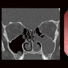 HNO & Radiologie: gemeinsam durch die NNH – ein Joint Venture (Webinar | Online)