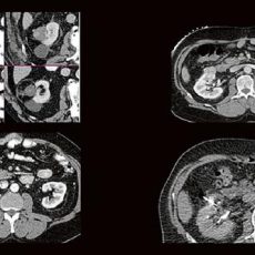 Thermoablation von Nierentumoren (Webinar | Online)