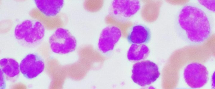 Unterstützende Begleitung bei hämatologischen und onkologischen Erkrankungen (Sonstiges | Essen) Unterstützende Begleitung bei hämatologischen und onkologischen Erkrankungen (Sonstiges | Essen)